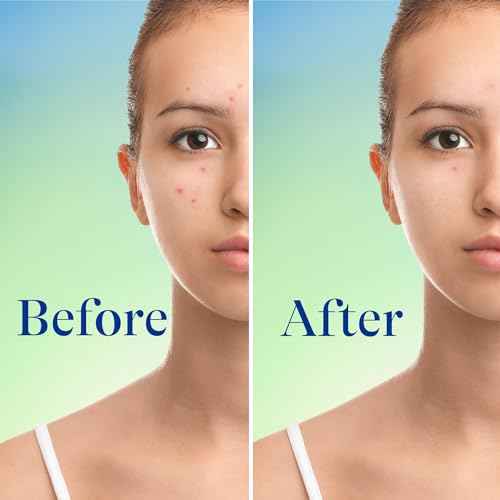 Differin Acne Face Wash with 10% Benzoyl Peroxide, Maximum Strength OTC Acne Foaming Cleanser, Fast Acting Acne Treatment for Face and Body, 5 oz.