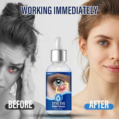 Stye Eye Treatment, Natural Stye Remover, Eye Stye Relief Serum, Premium Formula - Gentle Cleanser for Chalazion & Blepharitis (1 Fl Oz (Pack of 1))