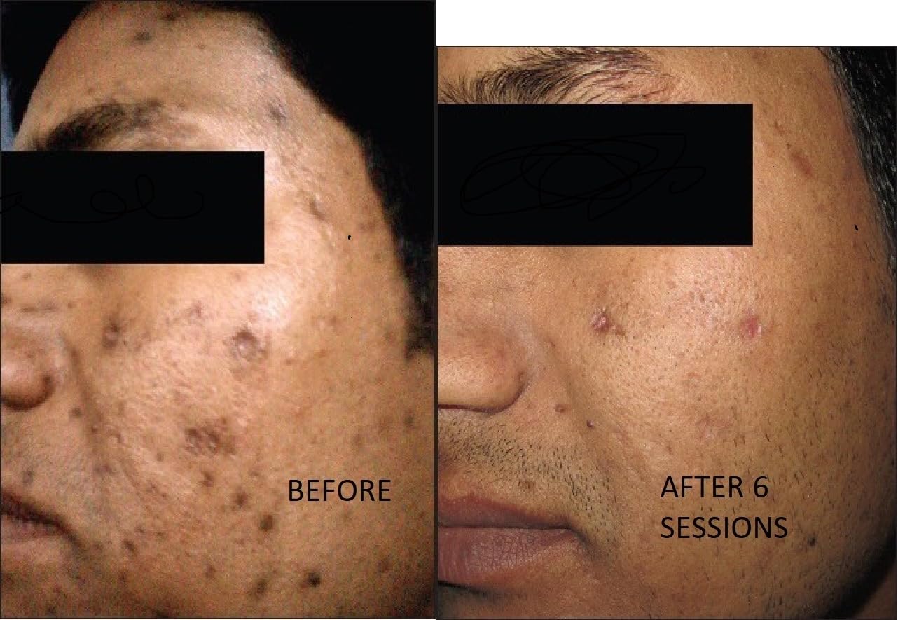 TCa 100% Peel - Medium Depth Chemical Peel for Scars | 0.3oz/10ml - Ideal for Aestheticians & DIY Skincare