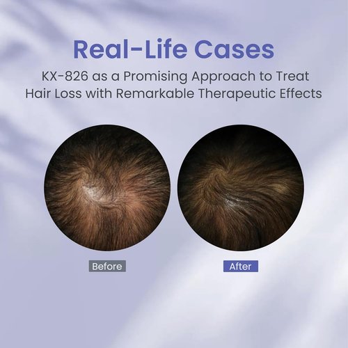 KINTOR Hair Regrowth Spray - 0.9% KX-826 Formula for Healthy Hair Growth | Oil Control, 60ml