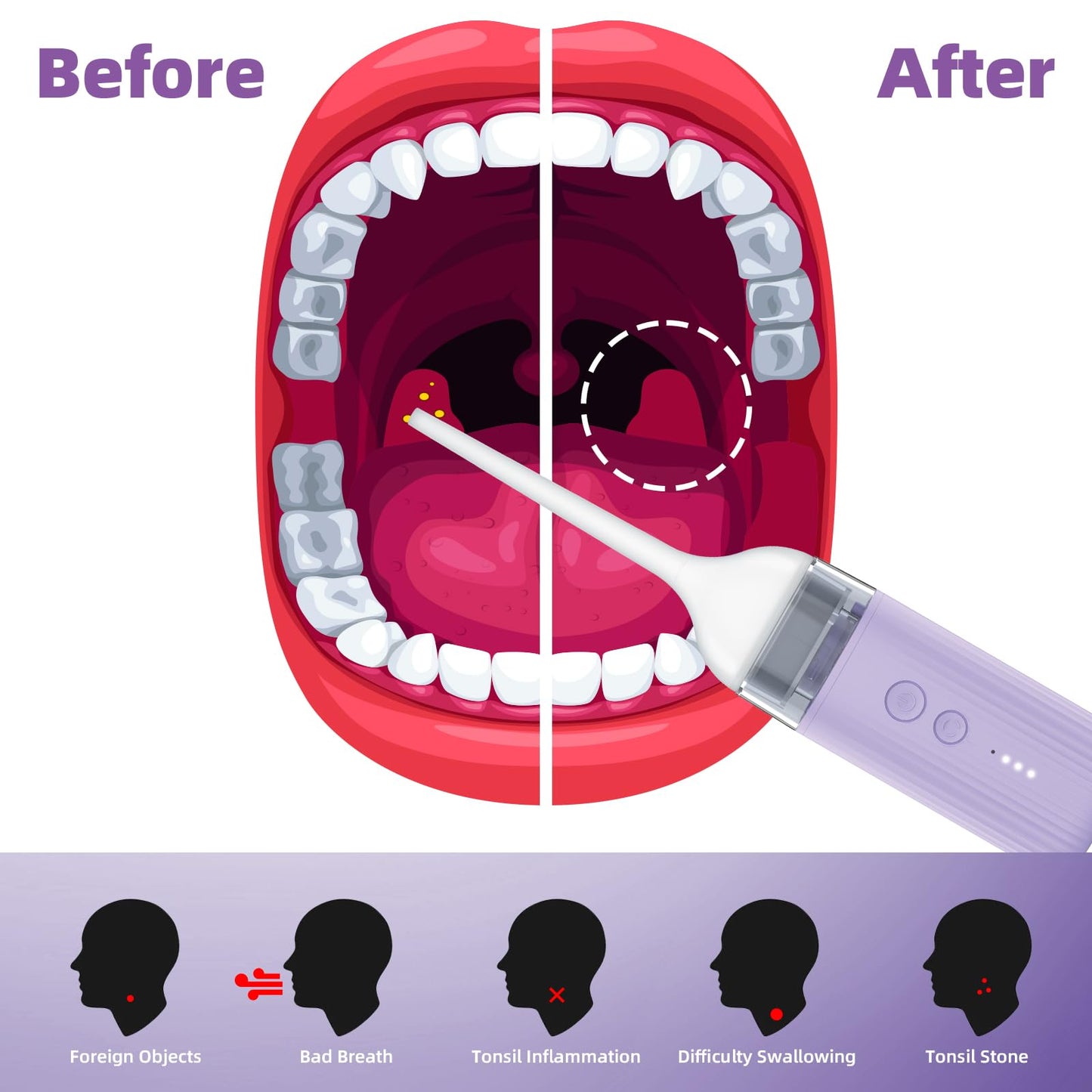 LMKEZHAN Tonsil Stone Remover, Tonsil Stone Removal Kit with 4 Levels Suction Mode, Rechargeable Tonsil Stone Vacuum, Silicone Tonsil Stone Removal Kit, IPX7 Waterproof, Tonsil Stone Remover Tool