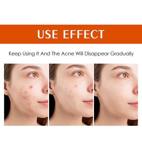 Acne Treatment for Face, Acne Cream Back Acne Treatment Cream for Teens & Adults Anti-acne Moisturizer Pimple Cream Butt Acne Clearing Cream, Acne Spot Treatment for Breakouts Blemish 30g