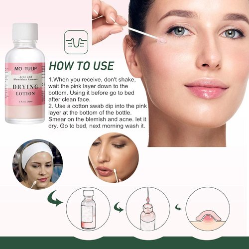 MO TULIP Acne Drying Lotion - Overnight Spot Treatment for Face & Body | 1 oz Pimple & Blemish Solution