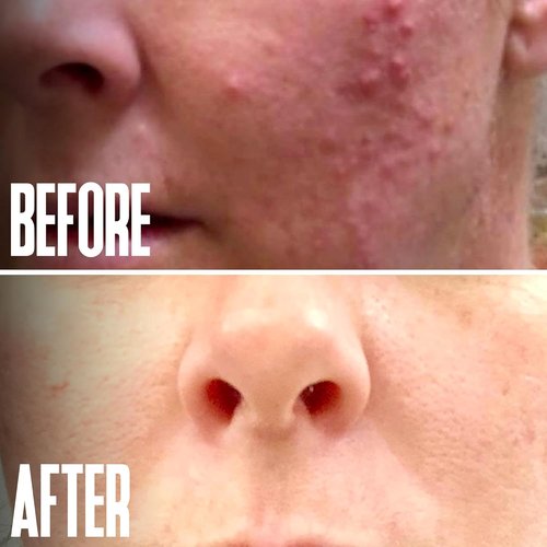 Alpha Hydroxy Acid | Glycolic Acid Peel 40% - Professional Exfoliating Treatment for Acne Scars & Wrinkles