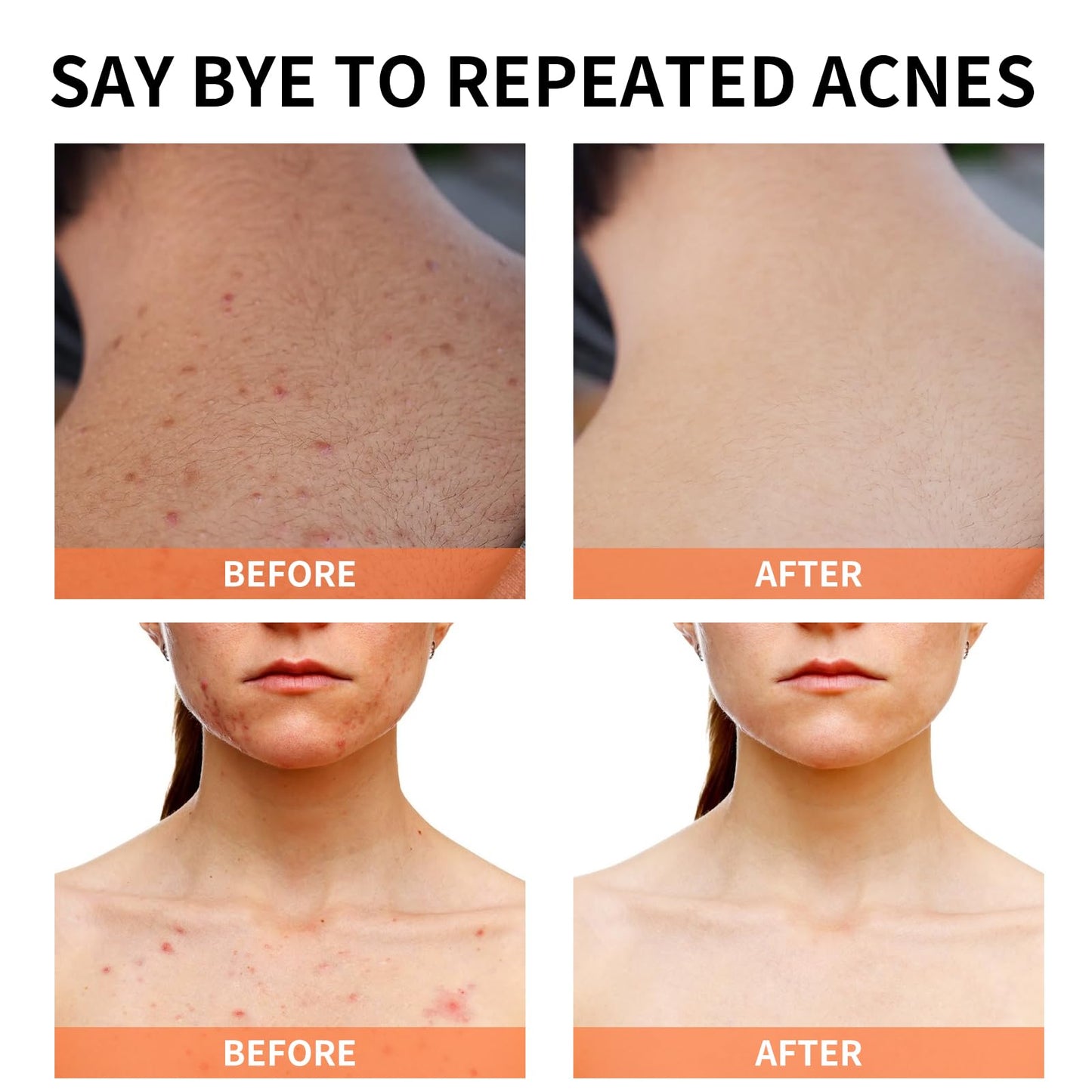 Acne Treatment for Face, Acne Cream Back Acne Treatment Cream for Teens & Adults Anti-acne Moisturizer Pimple Cream Butt Acne Clearing Cream, Acne Spot Treatment for Breakouts Blemish 30g