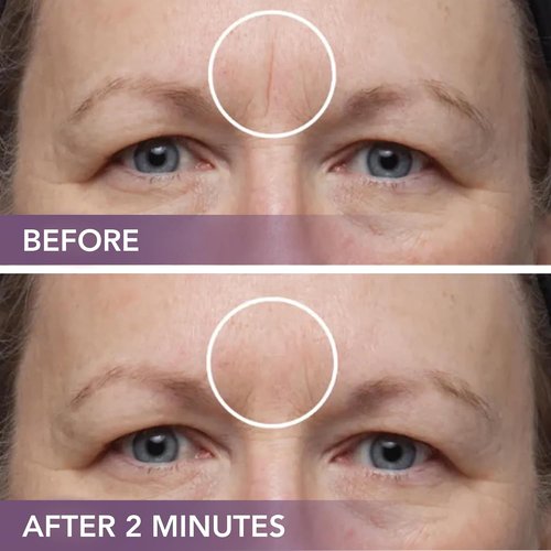 Dermaflage Scar Filler Kit - Waterproof Concealer for Deep Scars & Wrinkles - Bronze Dark, 1 Month Supply
