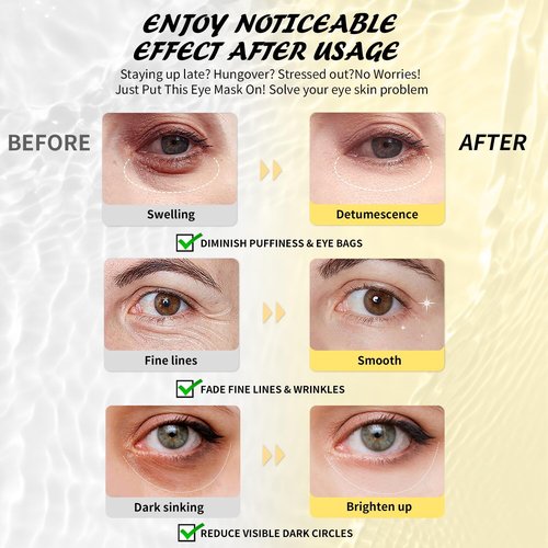 Maskiss Under Eye Patches (25 Pairs), Hyaluronic Acid Eye Masks for Dark Circles Puffy Eyes Undereye Bags, Collagen Eye Patches for Wrinkles and Hydrate, Eye Skin Care Christmas Gift for Women & Men