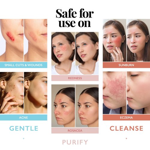 Hypochlorous Acid Spray for Face and Skin; Facial Cleanser | 32oz Refill Face Mist Hypochlorous Acid Spray for Skin, Acne, Rash, Eczema, Wound | Antimicrobial Facial Cleanser Acne Mist; Smart Skincare