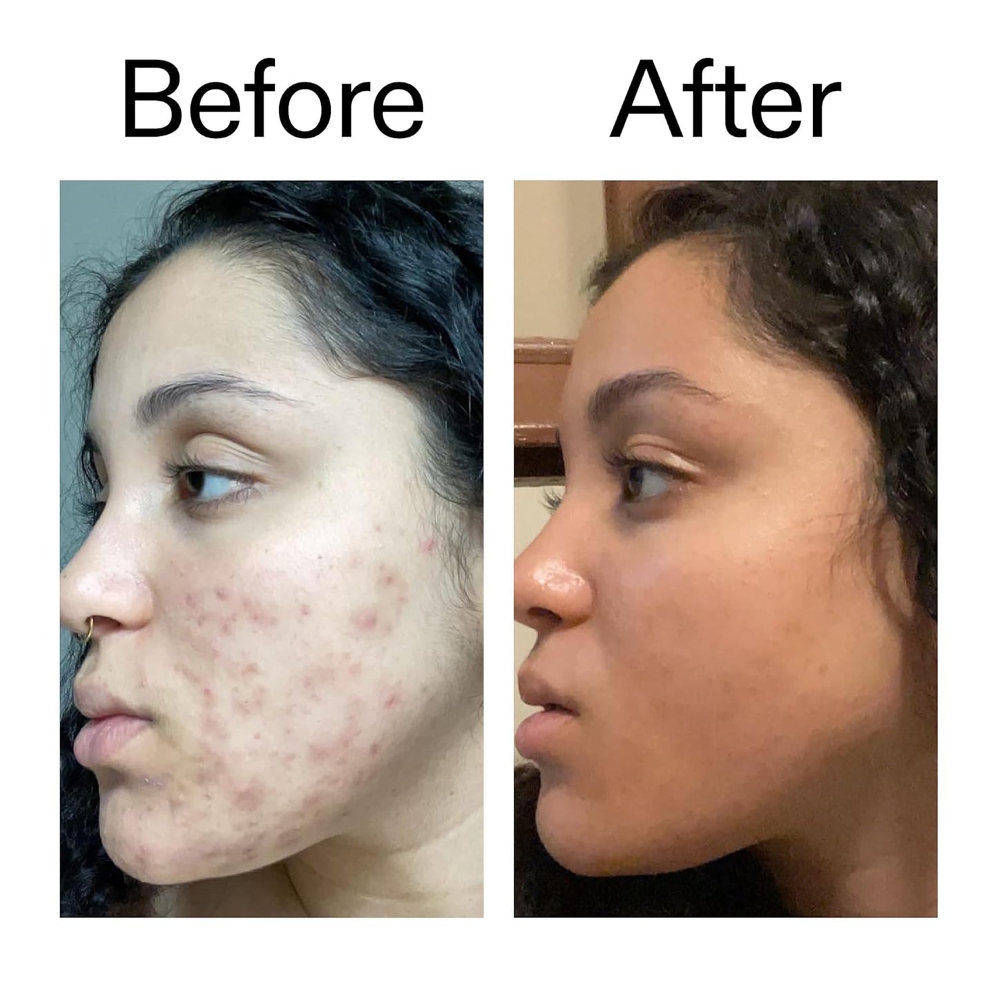 The INKEY List Tranexamic Acid Serum - Reduce Dark Spots & Skin Discoloration | 1 fl oz