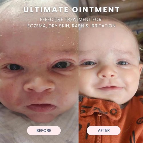 Noodle & Boo Ultimate Ointment for Babies – Multi-Purpose Skin Protectant for Eczema, Dry Skin, and Minor Irritations – Pediatrician-Tested, Gentle for Sensitive Skin