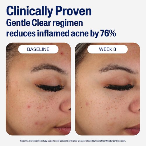 Cetaphil Face Moisturizer - Gentle Clear Mattifying Acne Treatment with 0.5% Salicylic Acid | 3oz