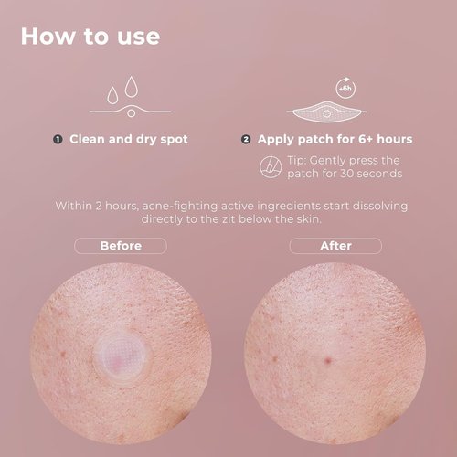 OMMA Korean Microdart Acne Patch - Effective Cystic Acne Treatment with Salicylic Acid & Tea Tree | 17mm Pimple Patches (18 Count)