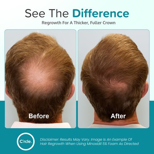 Minoxidil for Men Foam 5% - Unscented 3 Month Supply - Helps Restore Vertex Hair Loss & Thinning - 5% Minoxidil Foam For Men - Extra Strength Supports Hair Regrowth