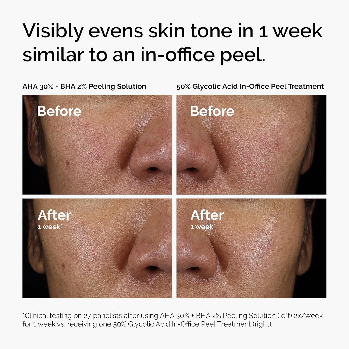 The Ordinary AHA 30% + BHA 2% Peeling Solution - Advanced Exfoliating Peel for Radiant Skin