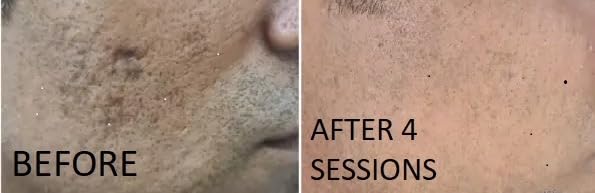 TCa 100% Peel - Medium Depth Chemical Peel for Scars | 0.3oz/10ml - Ideal for Aestheticians & DIY Skincare