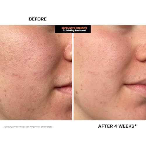 Kate Somerville ExfoliKate Intensive Exfoliating Treatment ? Salicylic Acid and Lactic Acid Super Facial Scrub and Mask, Improves Texture and Pores, 0.5 Fl Oz