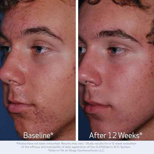 Obagi CLENZIderm M.D. Pore Therapy Exfoliating BHA Toner - Unclogs Pores with 2% Salicylic Acid Acne Treatment ? 5 oz