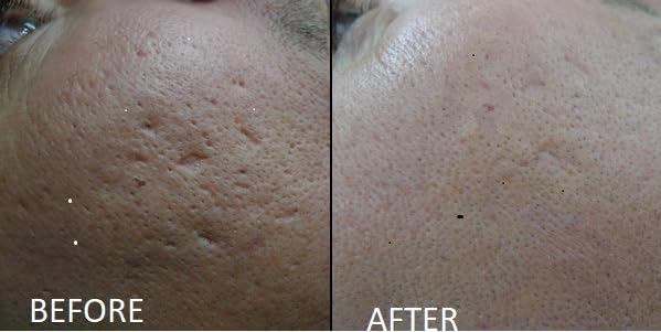 TCa 100% Peel - Medium Depth Chemical Peel for Scars | 0.3oz/10ml - Ideal for Aestheticians & DIY Skincare
