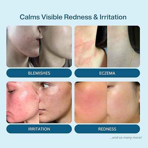 Honeydew Labs Hypochlorous Acid Spray ? HOCl Face & Skin Mist for Acne, Eczema & Irritation ? Multi-Purpose Skin Repair ? Eyelid Cleanser, Post-Workout, Post-Procedure, Scalp & Sensitive Skin ? 6.8 oz