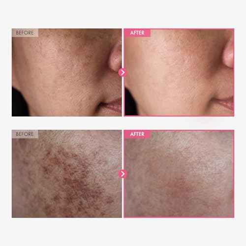 TOSOWOONG Arbutin 7% + Tranexamic Acid 4% Cream, 70,000ppm Arbutin, 40,000ppm TXA, Niacinamide, Glutathione, Dark Spots, Freckle, Blemishes, Pigmentation, Korean Skin Care, 50ml, 1.69 fl.oz.