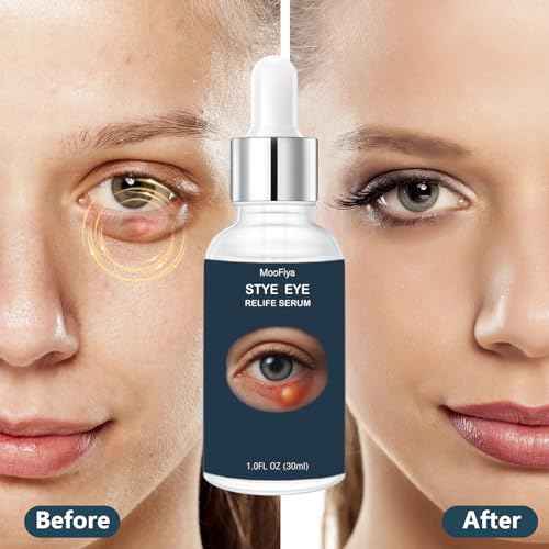 Stye Eye Treatment, Eye Reflief Serum for Styes and Chalazions, Non-Irritating, Eyelid Comfort Serum, Plant-based Formula, , (30ML-1 Fl Oz)