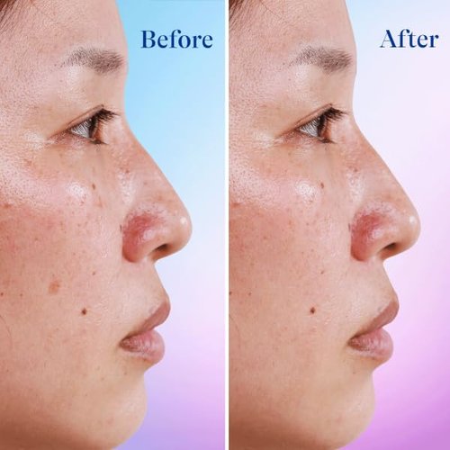 Differin Dark Spot Correcting Serum - Gentle Acne Treatment for Sensitive Skin | 1 oz