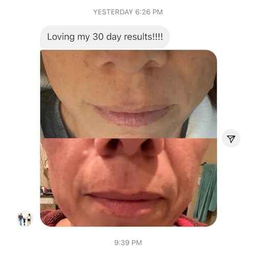 Bundle-2 Items: Frownies Forehead & Between Eyes (144 Patches) + Frownies Corners Of Eyes And Mouth (144 Patches) Combo Pack