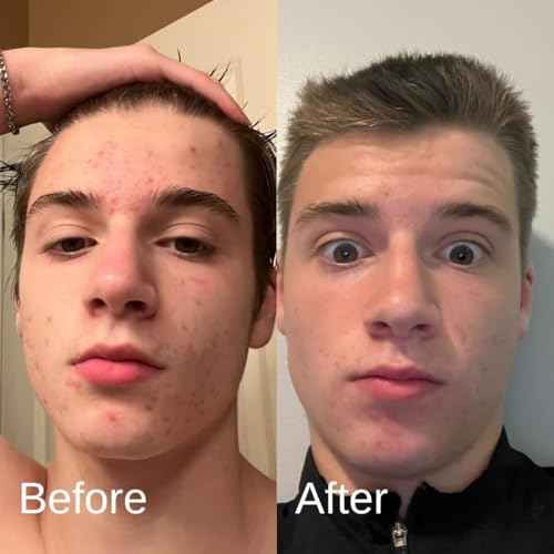 Acne System for Men and Boys, Face Wash, Moisturizer, Pimple Patches, Shield Men's Skin Care Set (2 Months)