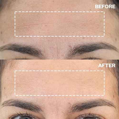 Wrinkles Schminkles Forehead Wrinkle Patches - Reusable Silicone Smoothing Pads for Brow Lift, Wrinkle Smoothers, Reduce Frown Lines & Face Lift (2 Pack)