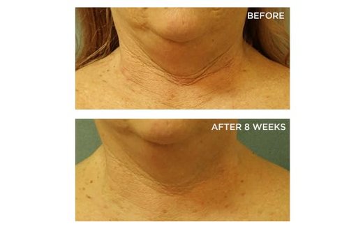 Perricone MD Cold Plasma Plus+ Neck Firming Cream - Broad Spectrum SPF 25 for Tightening & Smoothing Crepey Skin