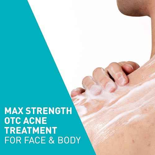 CeraVe Acne Foaming Cream Wash, Gentle Face and Body Cleanser with Benzoyl Peroxide 10%, Hyaluronic Acid, and Niacinamide, 10% Benzoyl Peroxide Treatment Clears Pimples and Blackheads 5 Oz