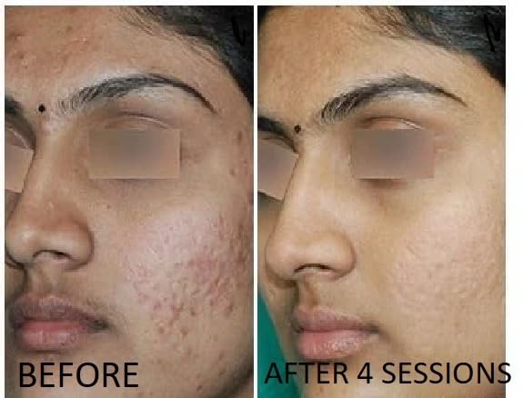 TCa 100% Peel - Medium Depth Chemical Peel for Scars | 0.3oz/10ml - Ideal for Aestheticians & DIY Skincare