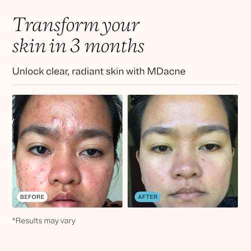 MDacne 3 Step Benzoyl Peroxide Acne Treatment Kit - Benzoyl Peroxide Cream 2.5%, Salicylic Acid Cleanser, Niacinamide Moisturizer ? Medicated Plant-Based Kit for Adult & Teen Acne, 30 Day Acne Kit