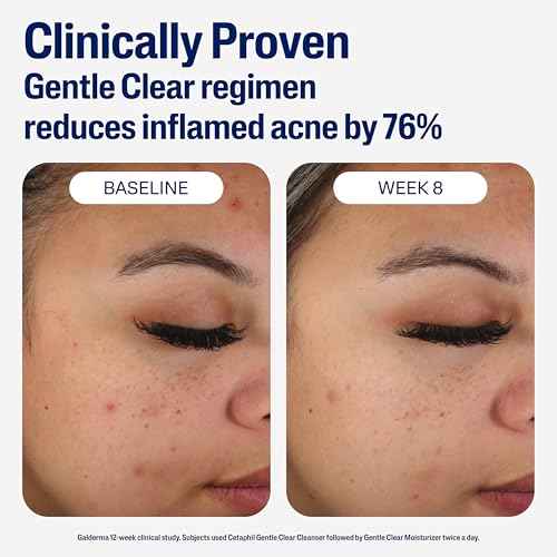 Cetaphil Face Moisturizer, Gentle Clear Mattifying Acne Moisturizer With 0.5% Salicylic Acid, Hydrates and Treats Sensitive Acne Prone Skin, Skin Care for Sensitive Skin, 3oz