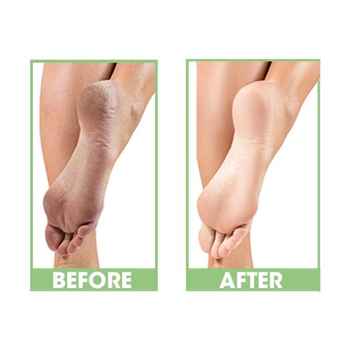 ProLinc Dry Heel Eliminator - Fast Absorbing Hydration for Dry Heels & Feet | 4 Fl. Oz, Made in the USA