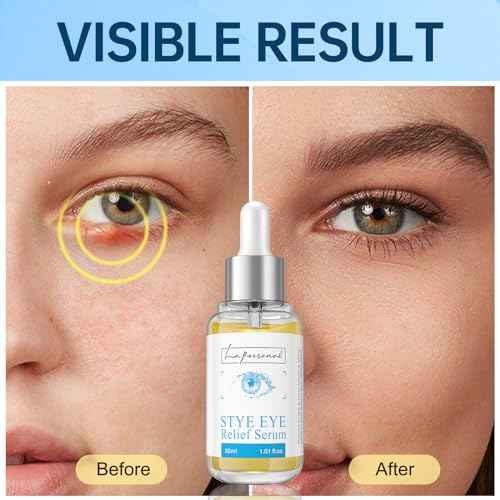 LA.PERSONAL Stye Eye Treatment, Chalazion Remover, Eye Serum for Styes Chalazion and Blepharitis Treatment, with Avocado oil, Sea buckthorn oil & Caffeine 1.01 Fl oz/30 Ml