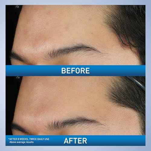 CeraVe Acne Foaming Cream Wash, Gentle Face and Body Cleanser with Benzoyl Peroxide 10%, Hyaluronic Acid, and Niacinamide, 10% Benzoyl Peroxide Treatment Clears Pimples and Blackheads 5 Oz