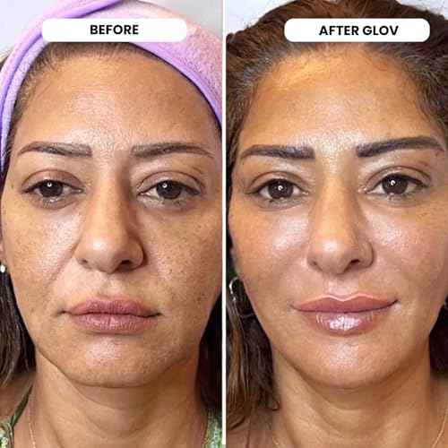 Glov Beauty Micro Infusion System for Face & Lips ? 0.25mm 24k Gold Cosmetic Facial Stamp with Hyaluronic Acid, Collagen Peptides & Licorice Root Serum Ampoules | At-Home Hydrating & Plumping Glow Kit