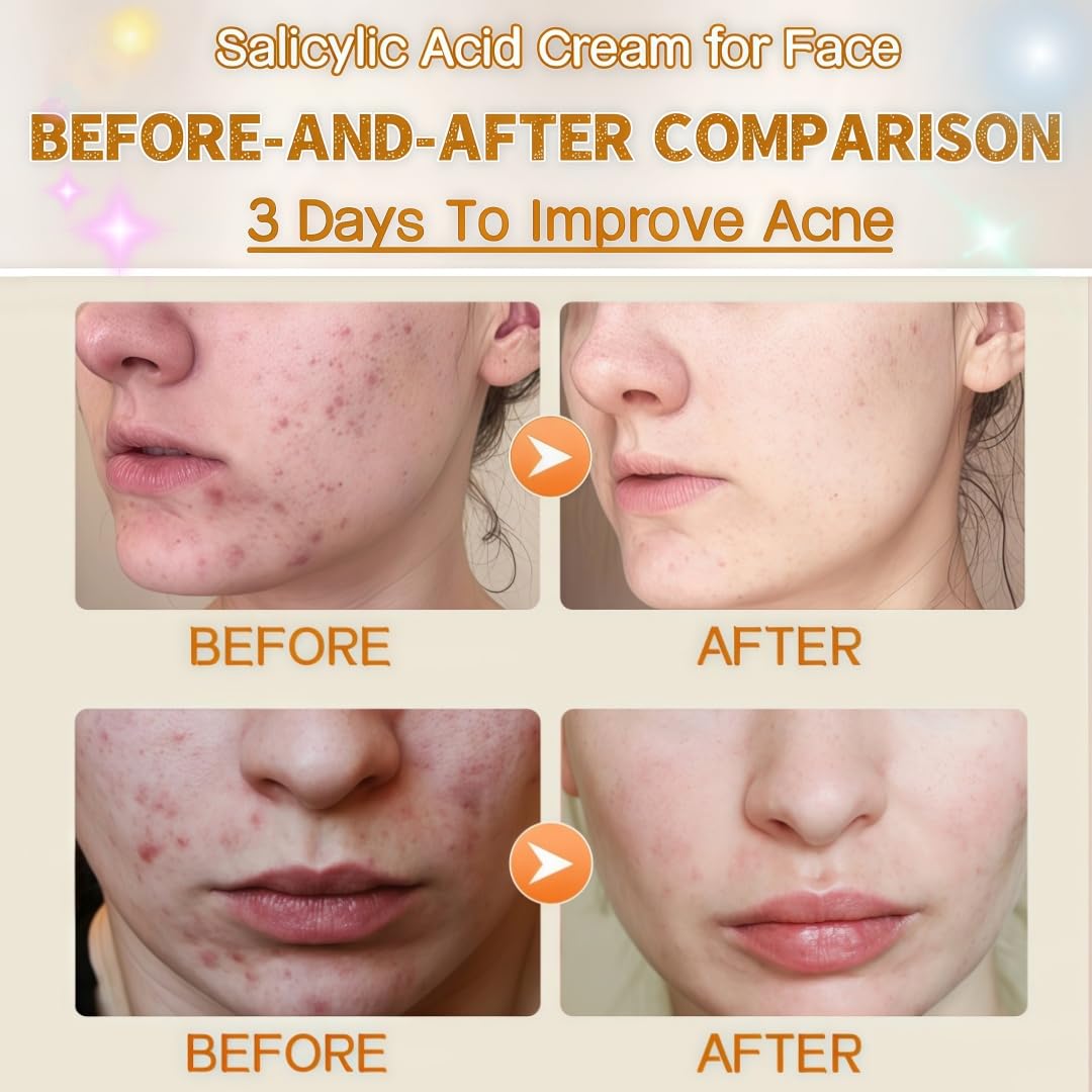 Skiennix Salicylic Acid Acne Treatment Face Cream - Oil Control & Pore Refining, 50ml / 1.69oz (2)