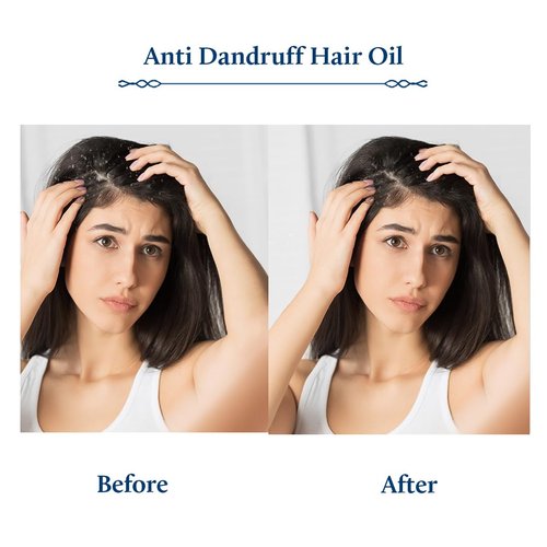 Blue Nectar Tea Tree Oil for Hair - Natural Anti-Dandruff Scalp Treatment | Ayurvedic Neem & Amla Blend (3.38 Fl Oz)