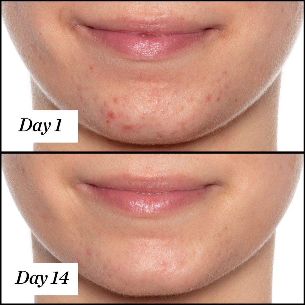 Sunday Riley U.F.O. Acne Treatment Face Oil - Ultra-Clarifying Salicylic Acid & Tea Tree Oil