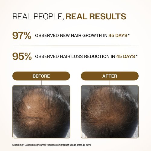 Bare Anatomy Advanced Hair Density Roll-On - 3% Redensyl, 4% Anagain & 5% Rosemary | Reduces Hair Fall & Supports Growth | 25ml