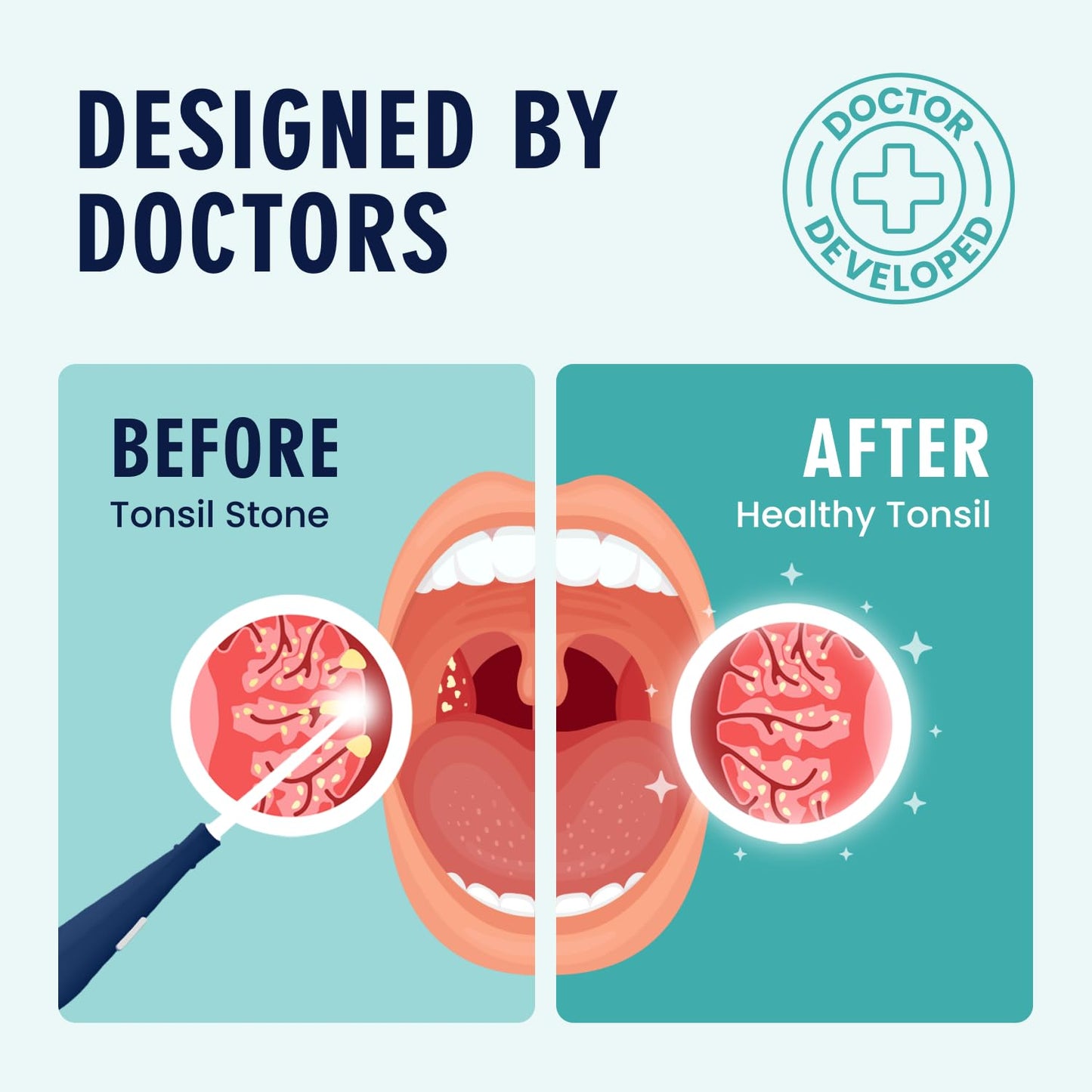 Dr. Frederick’s Original Easy Tonsil Stone Remover Kit - Fast Painless Tonsillolith Removal Tool - Fight Bad Breath - Pick and Oral Irrigator - 8 Pieces