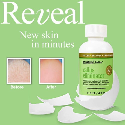 ProLinc Callus Eliminator - Fast Acting Formula for Smooth Feet | 4 Fl Oz