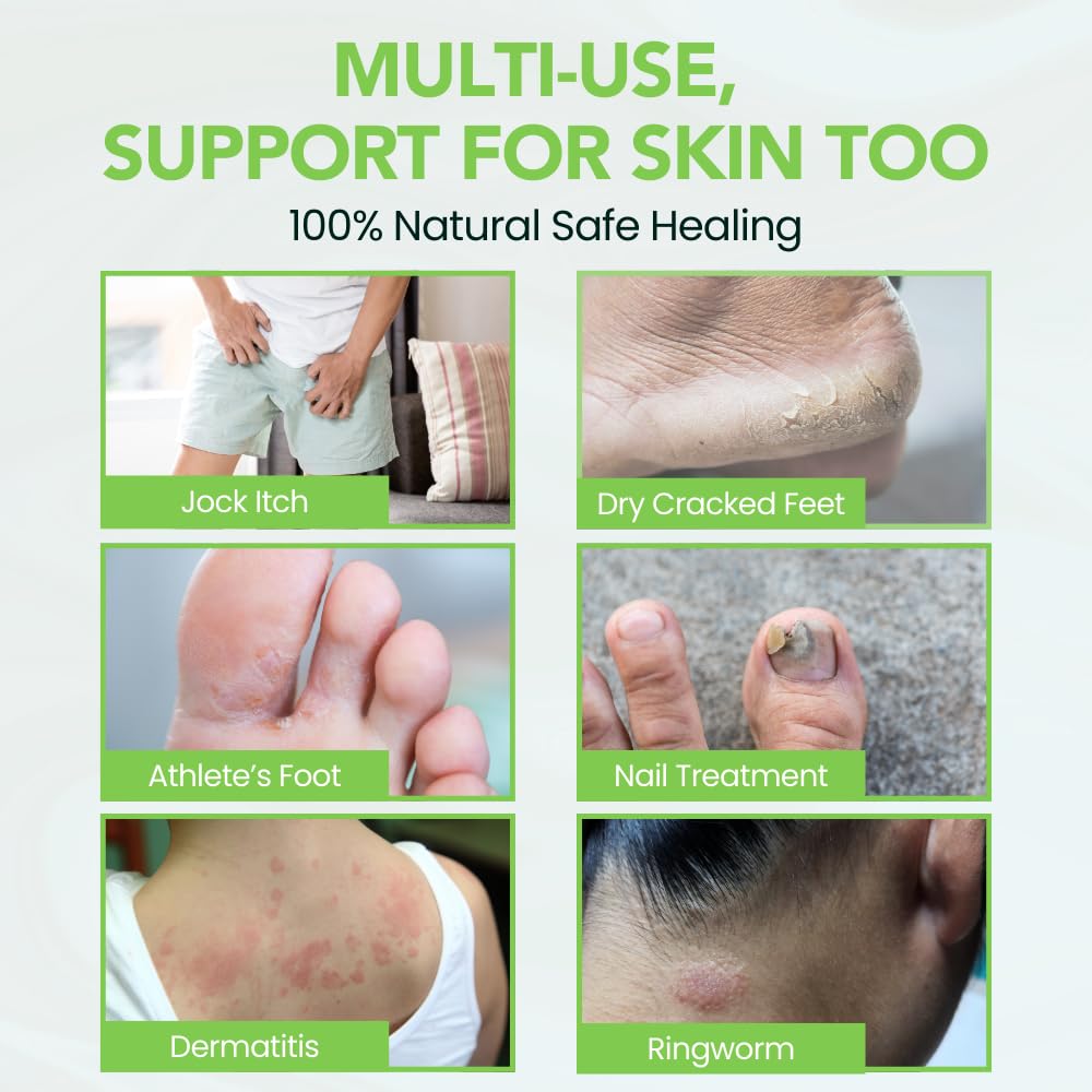 THENA Natural Wellness Athletes Foot Balm Extra Strength, Athletes Foot Treatment Cream, Heals Dry Cracked Feet Heels Itchy Skin Nails Toenails Advanced Foot Care for Men Women
