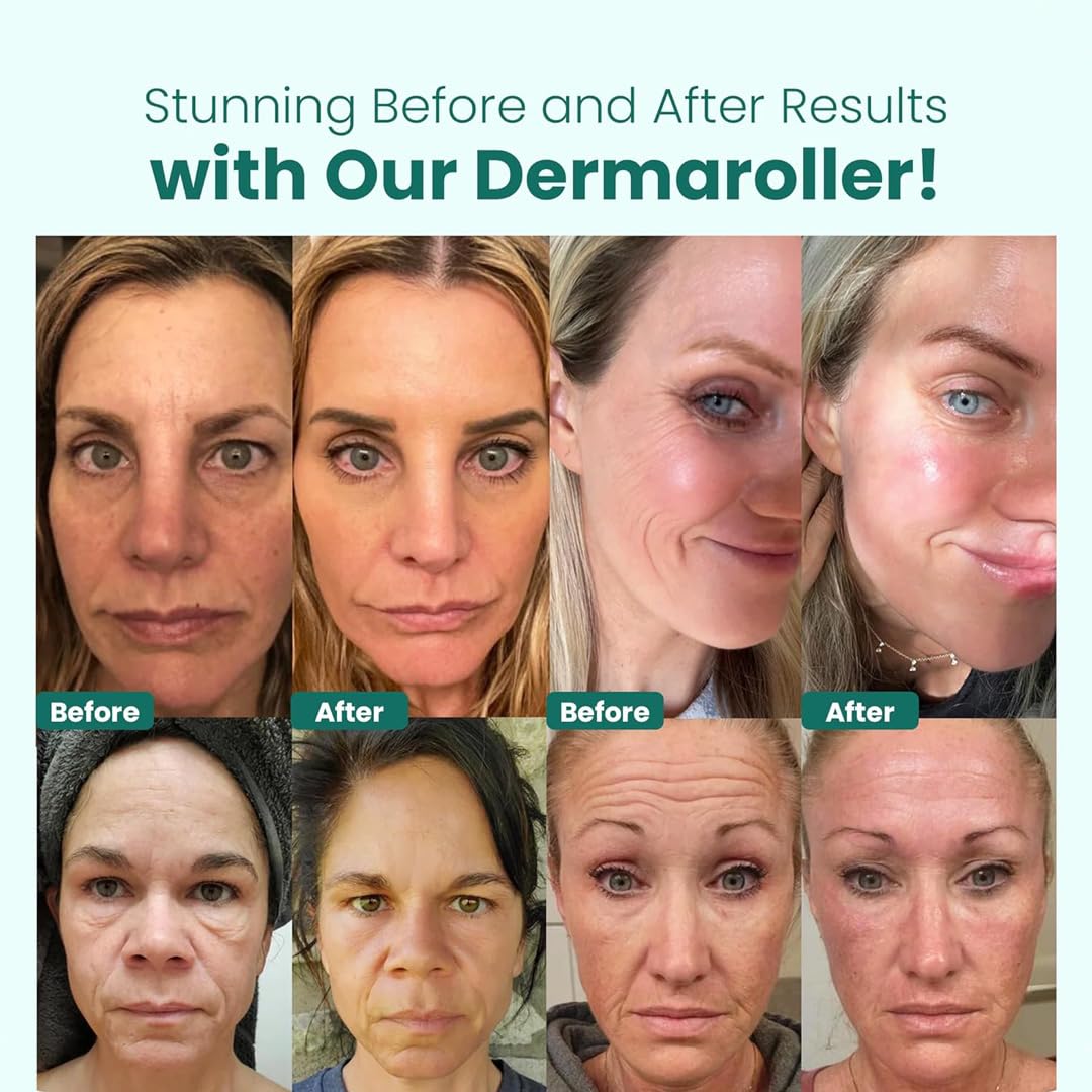 Gin Amber Beauty Derma roller (0.25mm) - 192 Real Individual Needles, Microdermabrasion Device for Skin Care, Serum Absorption with Microneedling, Safe and Painless Revitalizer Tool, Hygienic Case