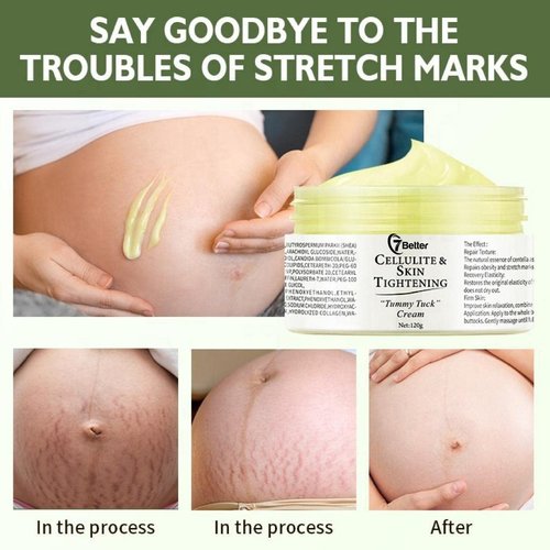 Regine Switzerland Stretch Marks & Scars Removal Cream - Firming & Repair for Pregnancy Skin