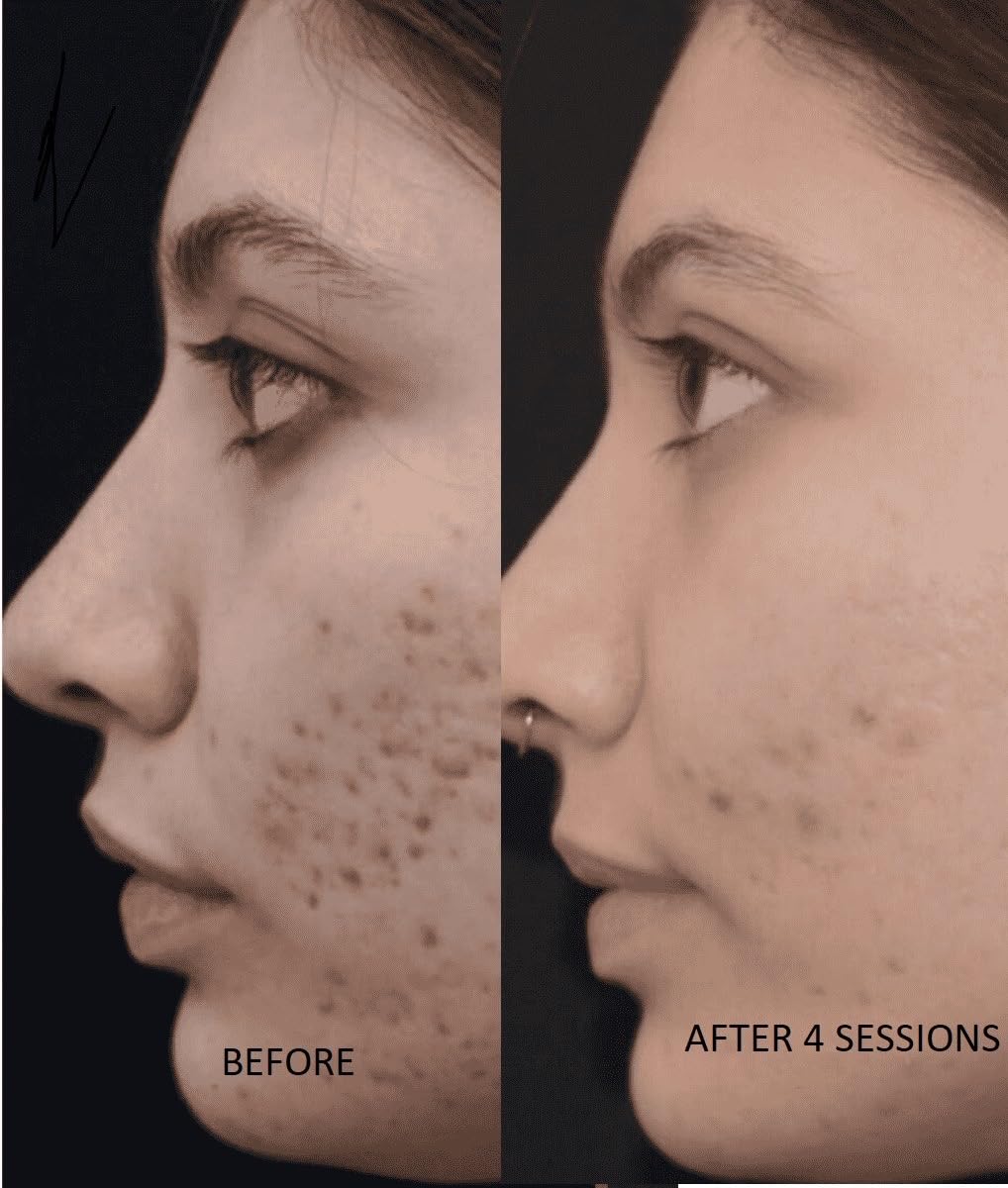 TCa 100% Peel - Medium Depth Chemical Peel for Scars | 0.3oz/10ml - Ideal for Aestheticians & DIY Skincare