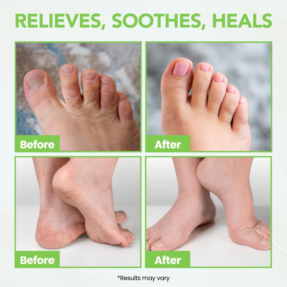 THENA Natural Wellness Athletes Foot Balm Extra Strength, Athletes Foot Treatment Cream, Heals Dry Cracked Feet Heels Itchy Skin Nails Toenails Advanced Foot Care for Men Women