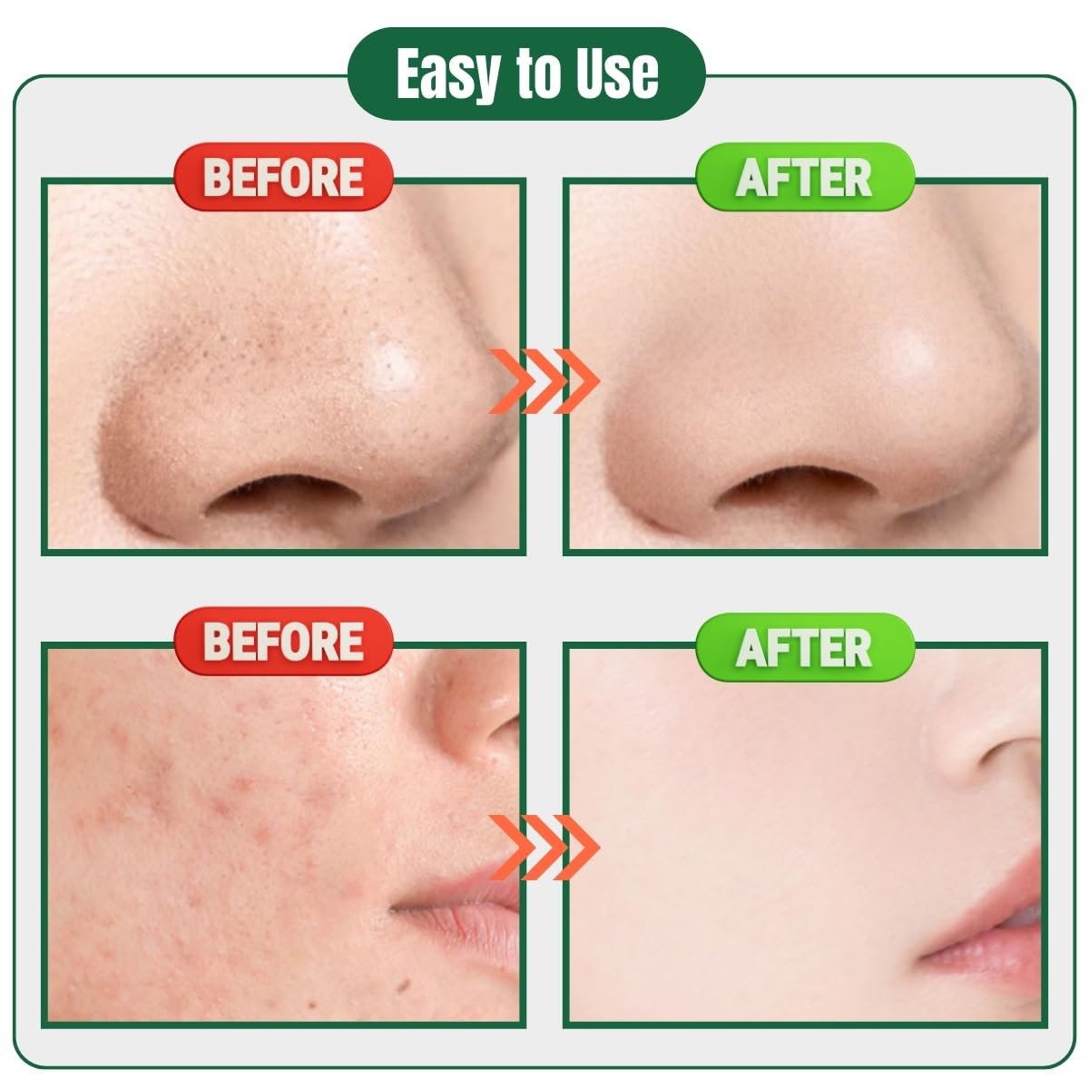 xwxwseui Usiveinborn Blackhead Remover Upgraded, Usiveinborn Blackhead Tweezers, Professional Upgraded Facial Blackhead Remover Tweezers, Blackhead Remover Tools Sets (A5-Rose-Gold-8pcs)